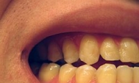 تأثير السكري على الأسنان
